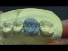 Live wax up - Upper 1st molar wax up( full )