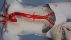 The ER-REBOA™ Catheter's Demonstration Video