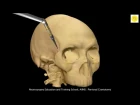 Neurosurgery 3D Animation Video : Pterional Craniotomy