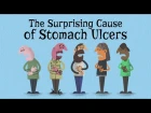 The surprising cause of stomach ulcers - Rusha Modi