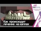 Скученность зубов. Как двигаются зубы при лечении на элайнерах Star Smile