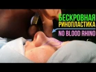 ЭТО ФАНТАСТИКА ! БЫСТРАЯ и БЕСКРОВНАЯ РИНОПЛАСТИКА ★ FANTASTIC ! : FAST and BLOODLESS RHINO