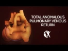 Total Anomalous Pulmonary Venous Return