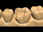 Posterior tooth preparations inlay, onlay, crownlay and crown