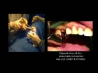 Physics Forceps Atraumatic Tooth Extraction Technique - Dr. Carl Misch