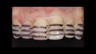 Керамические виниры. Porcelain veneers. Emax. Carillas Dentales. 牙齿镶