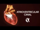 Atrioventricular Septal Defect - AV Canal